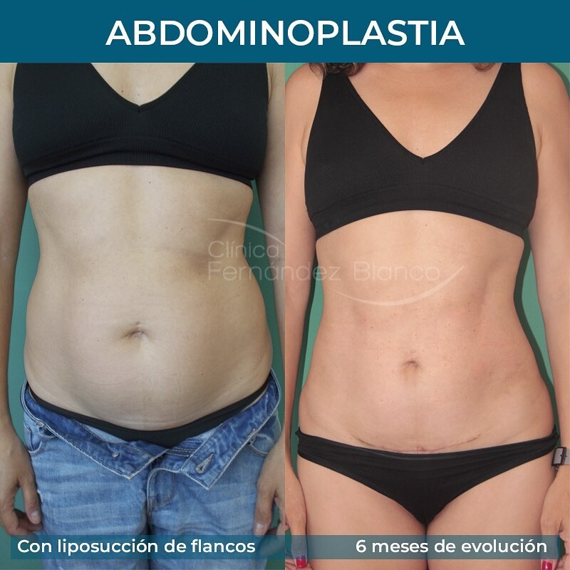 Before and After Result